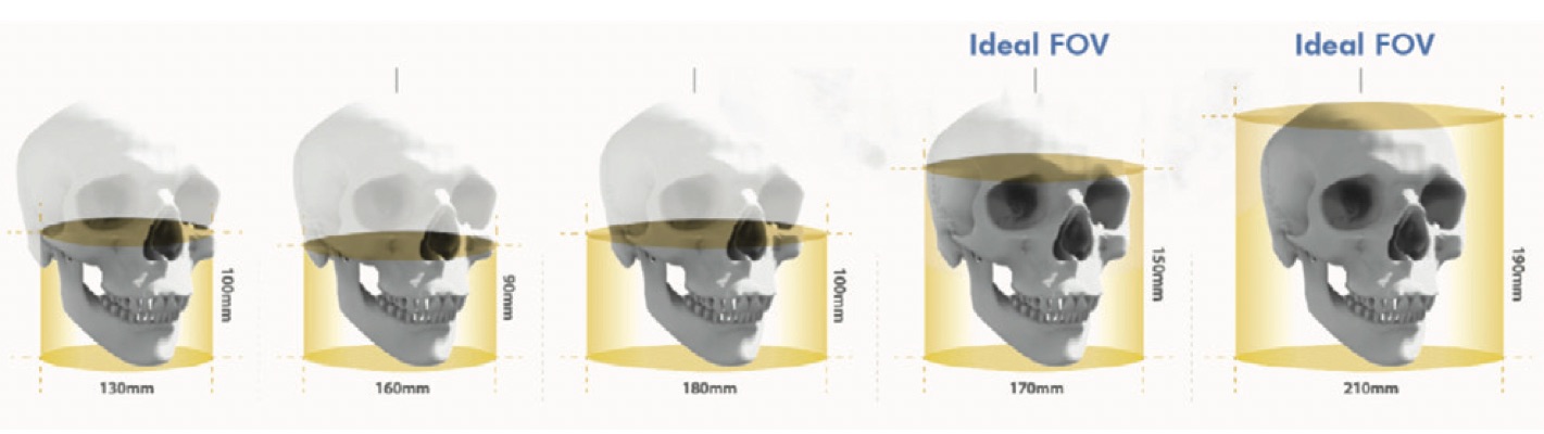 Différents types de FOV dans le CBCT