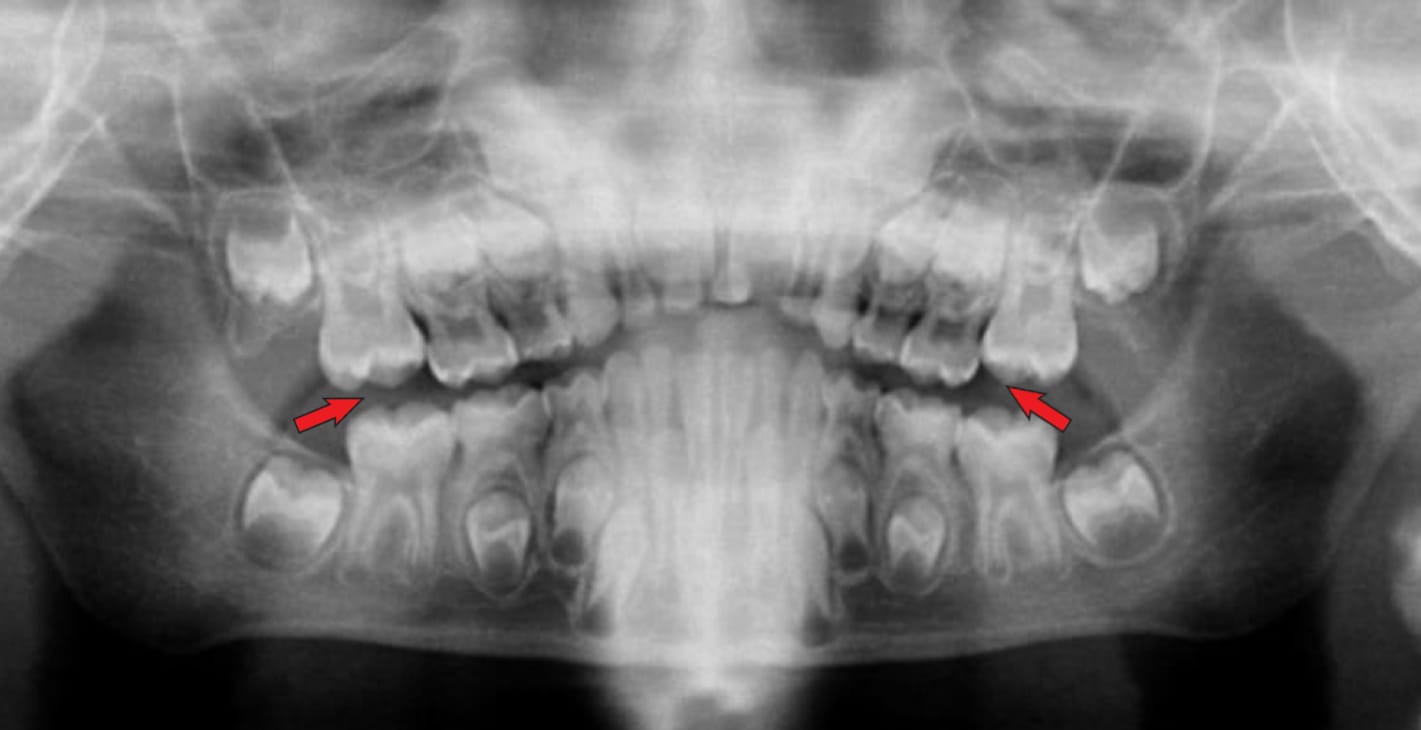 Ligne du sourire plate ou incurvée vers le haut OPG