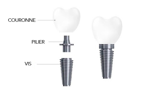 Parties qui forment un implant dental