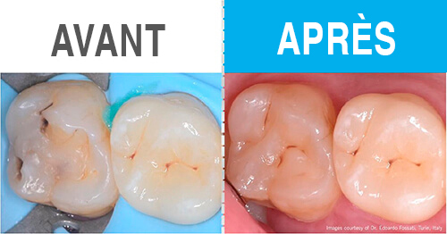 Réparation classe I avec composite Venus ONE Shade