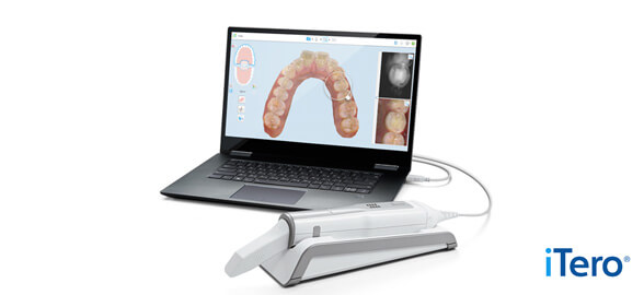 Scanner intraoral iTero Element 5D-Align Technology