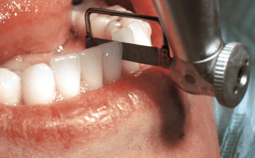 Diastèmes dentaires