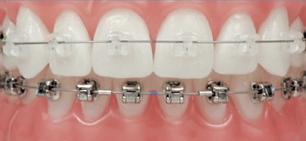 Brackets orthodontiques : connaissez tous les types, leurs utilisations