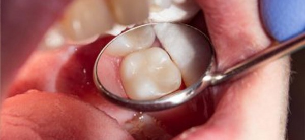 soins dentaires: Ciment dentaire provisoire  Dentaire, Santé bucco-dentaire,  Ciment dentaire