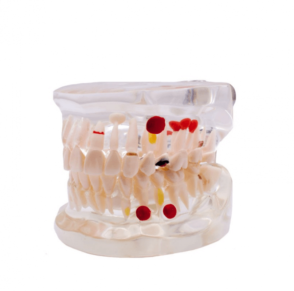 Modèle de dents pour démonstration de caries Img: 202008291