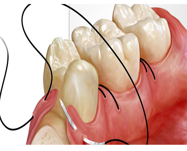 Sutures Non Résorbables