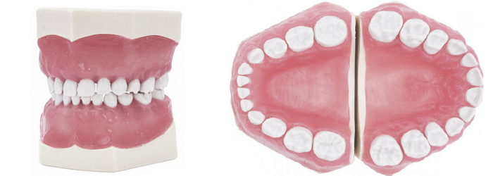Modèle de dents de maladie Dental modèle de dent orale modèle Medisch  implantation de