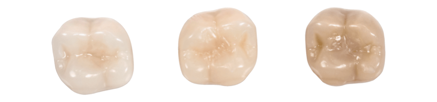 Cavités occlusales reliées avec Venus Diamond ONE en dents artificielles de couleur B1, A2 et C4