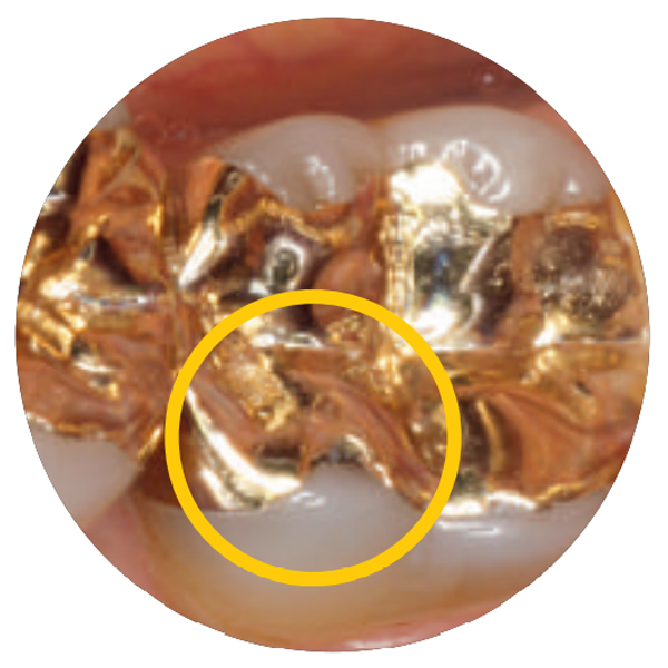  Caso clinico 2: Riparazione intraorale di un intarsio d'oro 