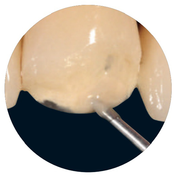 Caso clinico 4: Riparazione intraorale di un ponte in metallo-ceramica