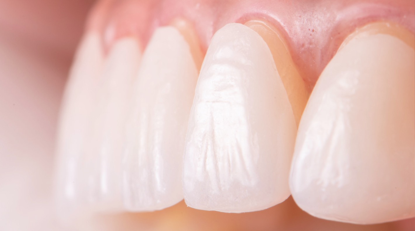 Ponti dentali