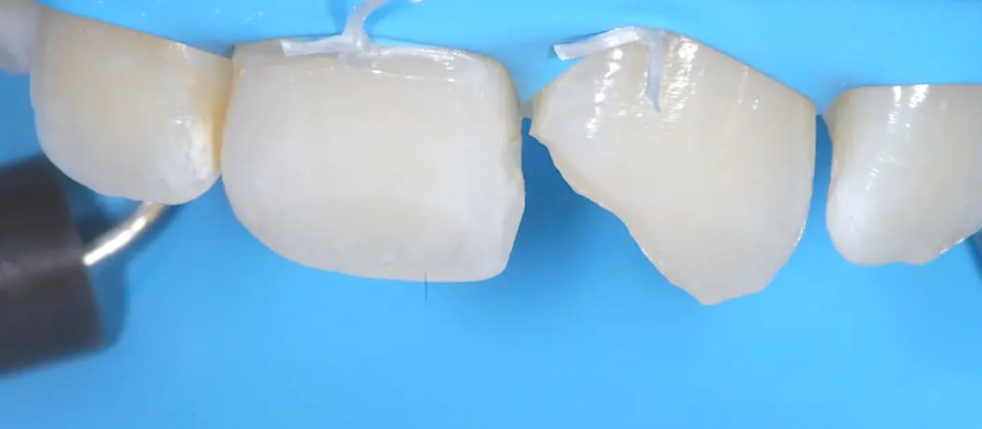 Isolamento assoluto da ripristinare con composito per evitare l'umidità Realizzazione dell'isolamento assoluto in un ripristino composito