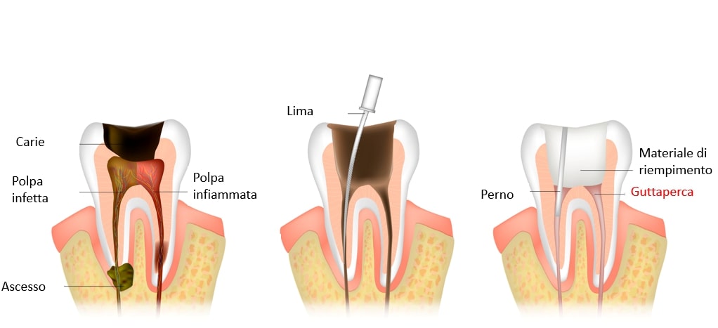 procedimento di otturazione con guttaperca