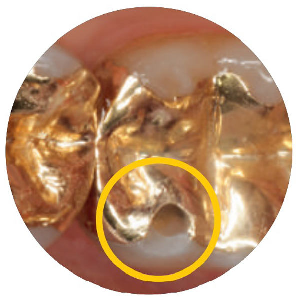 Caso clinico 2: Riparazione intraorale di un intarsio d'oro