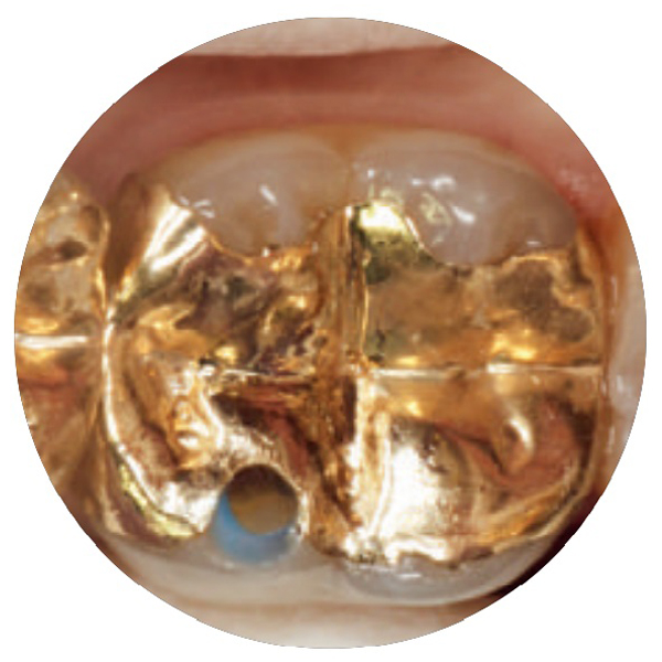  Caso clinico 2: Riparazione intraorale di un intarsio d'oro