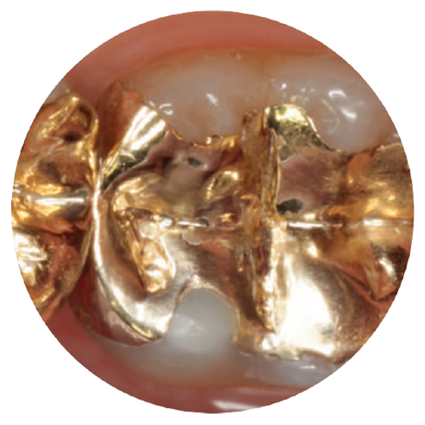  Caso clinico 2: Riparazione intraorale di un intarsio d'oro