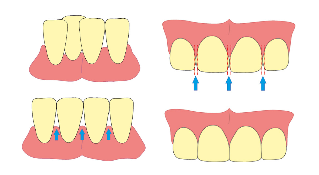 dental stripping treatment