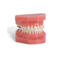 Modello di Denti Ortodontici Tipodonte Dentale con Staffe Mentali Denti Ortodontici con Legature Rosse