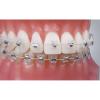 Bracket Ortodontici Estetico - RO RX - Ortho Classic - In Ceramica / Mini / Trasparente - Foto 14