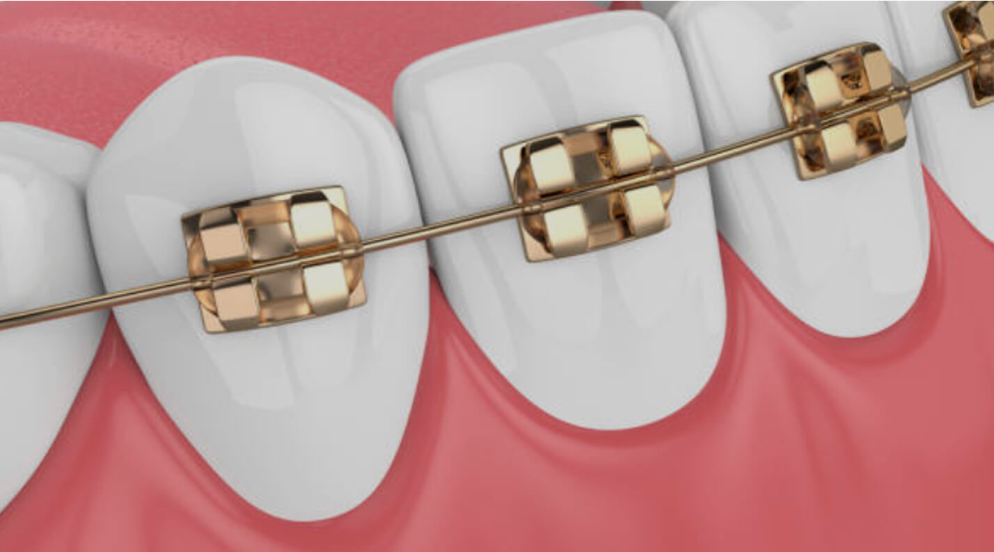 Tipos e funções dos arcos de ortodontia 