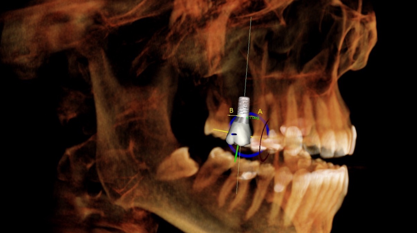 Usos da CBCT em Implantologia Oral e Maxilofacial