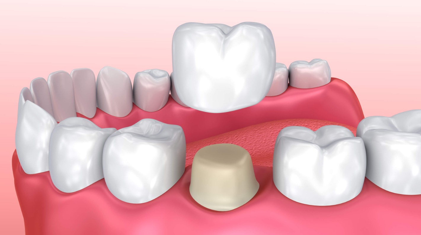 Pontes dentárias, coroas e facetas