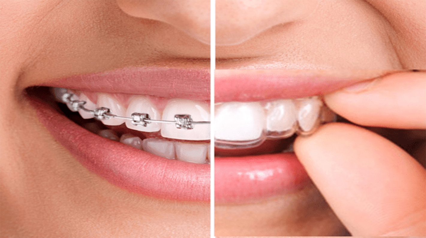 diferenças e semelhanças entre ortodontia tradicional e invisível