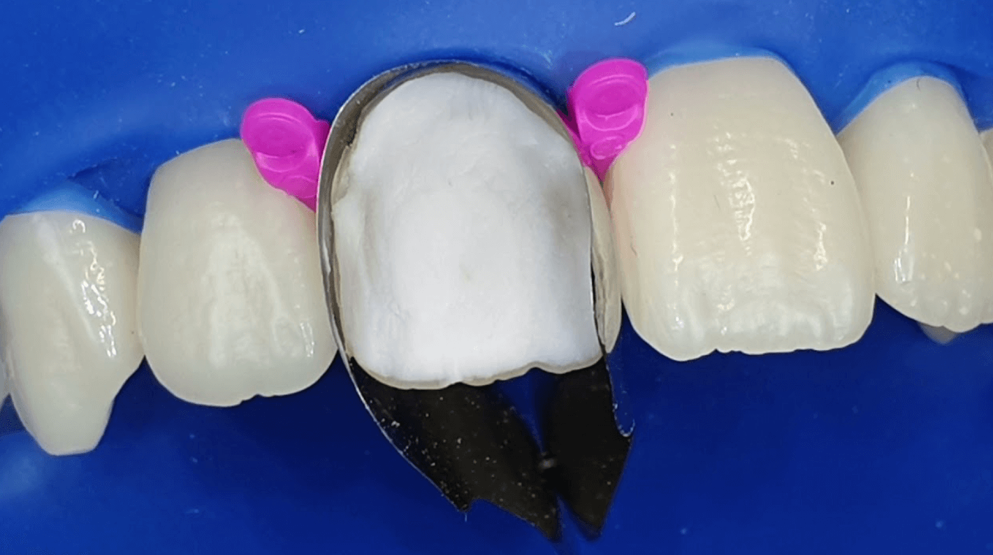 Alinhador invisível para ortodontia invisível
