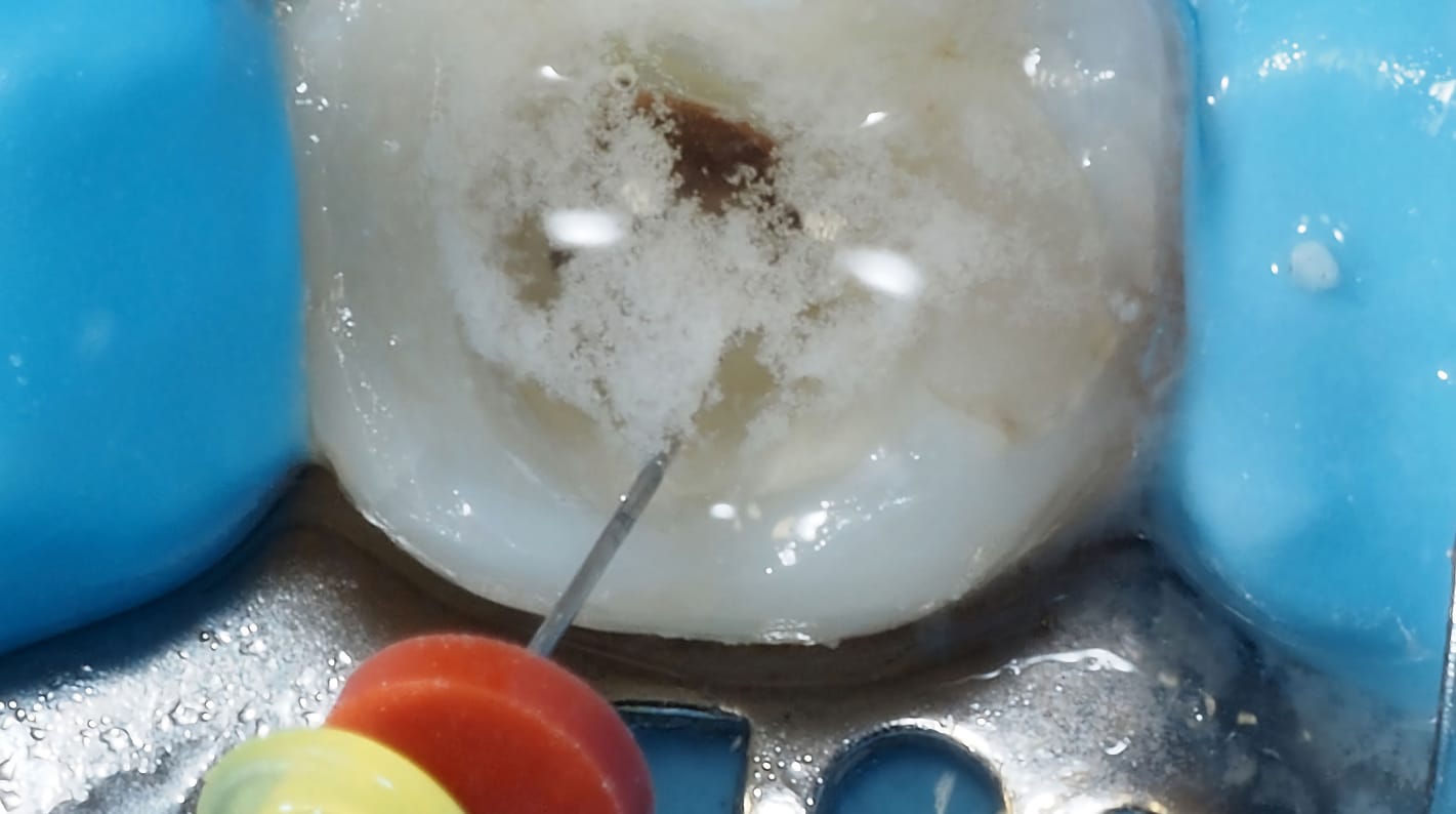Aghi Odontoiatria 100 Pezzi Aghi Per Irrigazione Endodontica 30GA - Punta Fine Chiusa, 2 Fori Laterali, Confezione Da 100 Pezzi Aghi Laboratorio Dentale - Foto 11