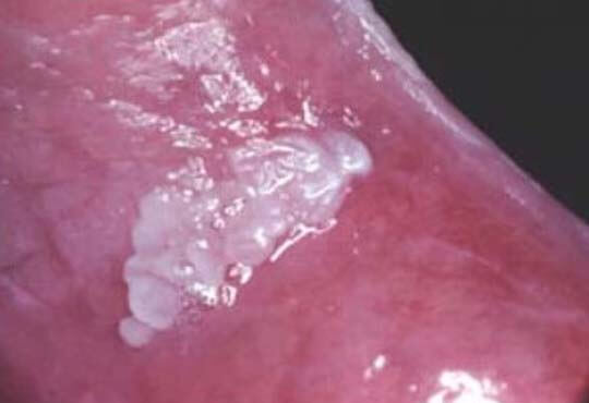 Leucoplasia Oral Pilosa 