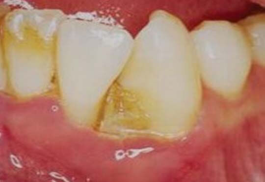 Periodontitis Ulcerativa Necrotizante