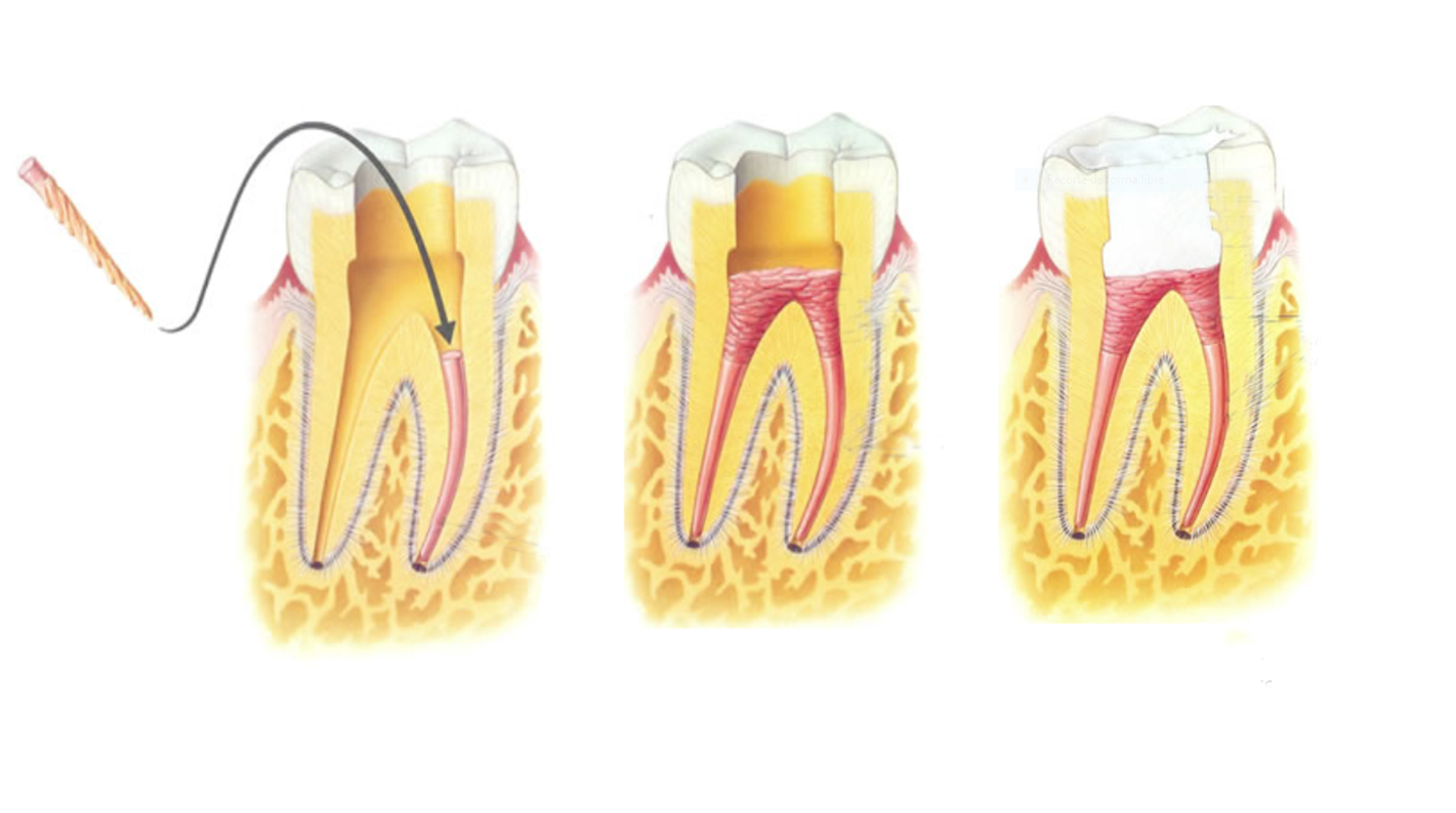 pontas de guttapercha em tratamentos de endodontia