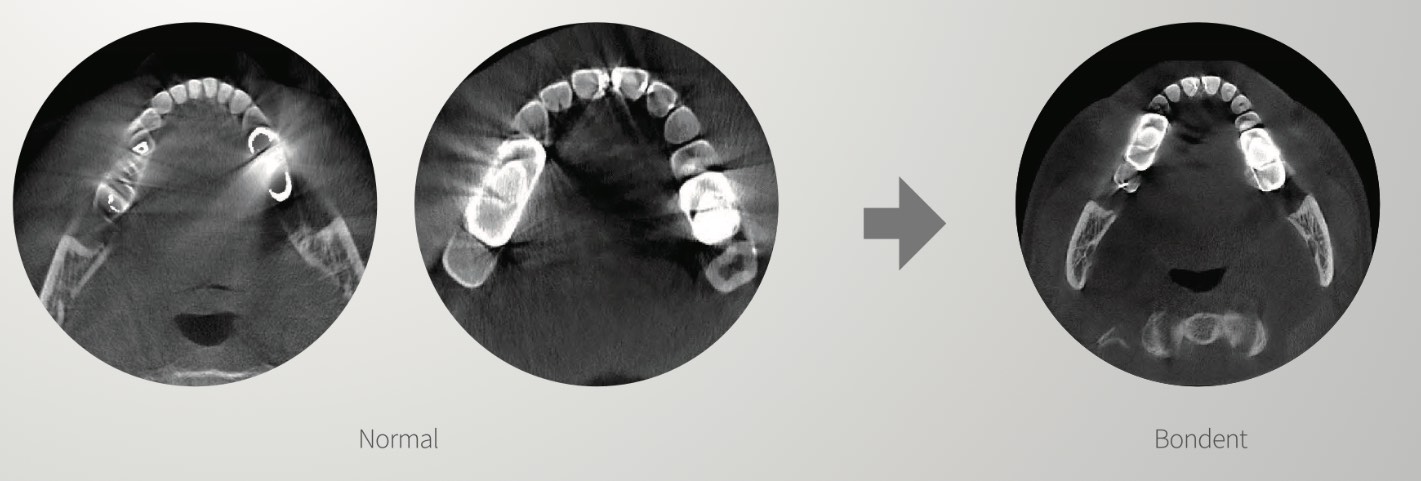 Redução de artefatos CBCT Bondent