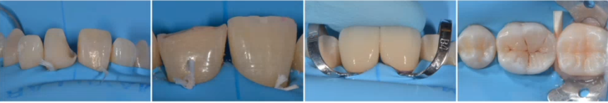Descolorações dentárias