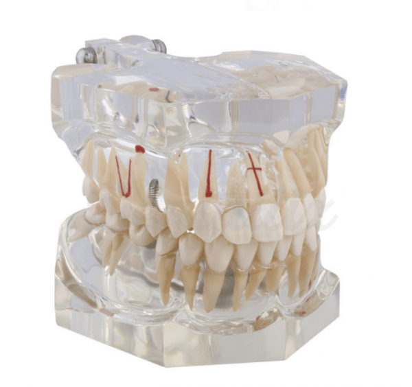 Macromodelo com Patologia Completa -Macromodelo dental Img: 202008221
