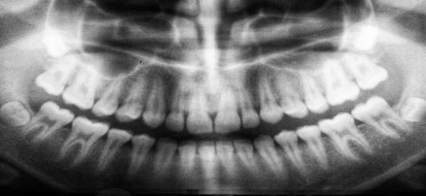 Quais são os passos para conseguir uma boa radiografía panorâmica