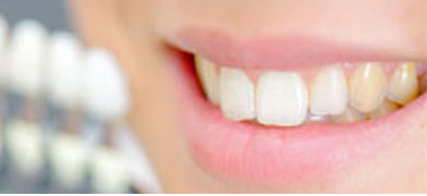 Dientes acrílicos: Consejos para encontrar el color y el nivel de translucidez correctos