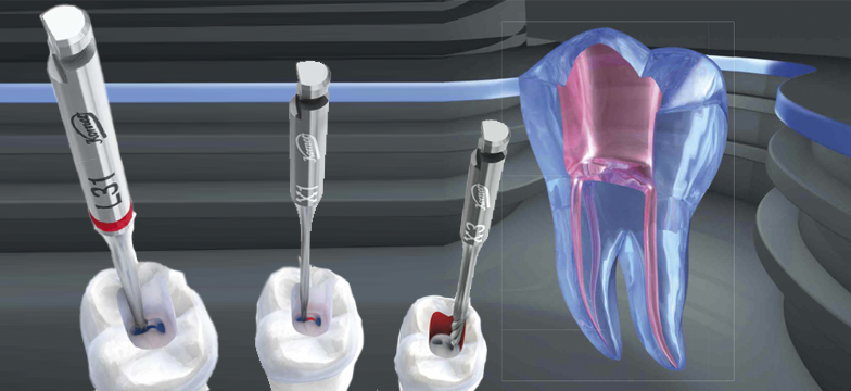 La importancia del acceso radicular para una Endodoncia exitosa