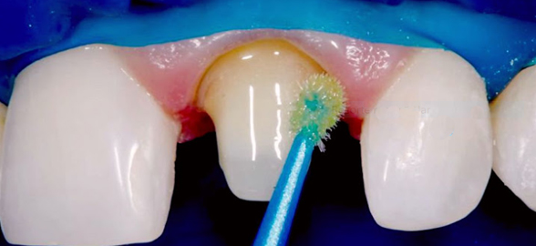 Adhesivos universales: la certeza de no volver a grabar dentina