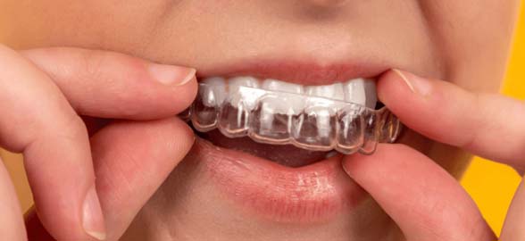 Alineadores invisibles: Preguntas frecuentes sobre este innovador tratamiento dental