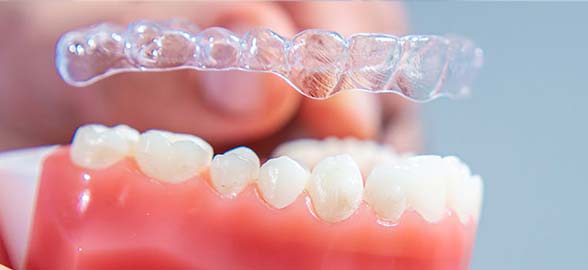 Alicates para alineadores invisibles Medicaline: Perfecciona la biomecánica de tus tratamientos.