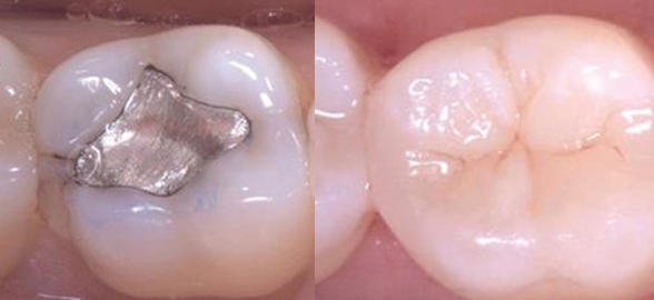 Alternativas a la amalgama: ¿Qué opciones hay actualmente en restauración dental?