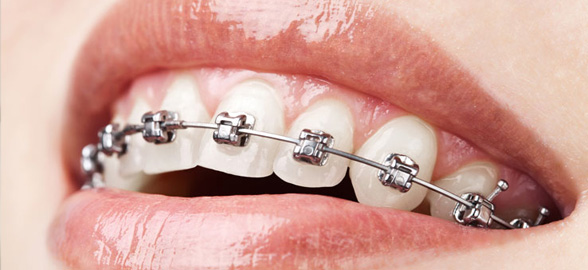 Arcos de ortodoncia: usos y características