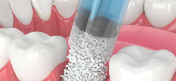 Biomateriales dentales para injertos óseos: La revolución de la regeneración ósea