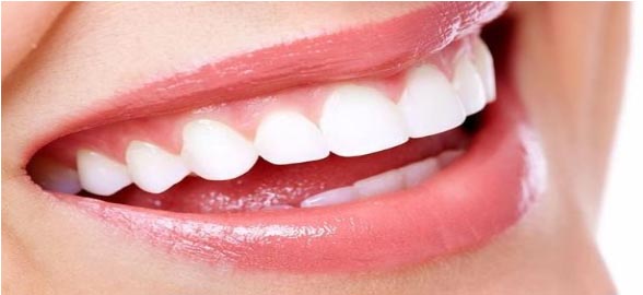 Diferencias entre blanqueamientos dentales con Peróxido de Hidrógeno y Peróxido de Carbamida