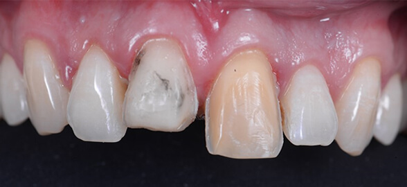 Rétraction gingivale