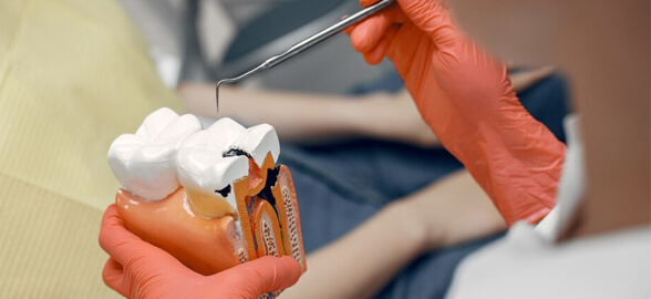 Cementos selladores para Endodoncia: Todo lo que necesitas saber para elegir el mejor