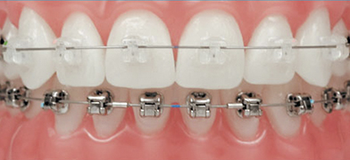 Brackets para Ortodoncia: conoce todos los tipos, sus usos y ventajas para tus tratamientos