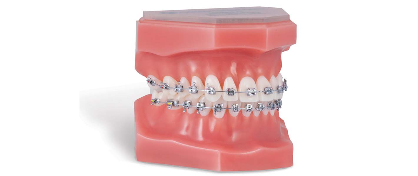 Metalic Brackets