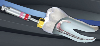 Sistema de limas Komet: Retratamiento de conductos radiculares